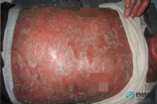 红皮病,红皮病属于什么类型的皮肤病