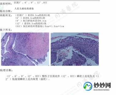 低级别鳞状上皮病变,低级别鳞状上皮内病变是什么意思