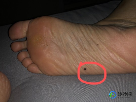 脚底有一颗痣,脚底板长了一颗痣以前没有的