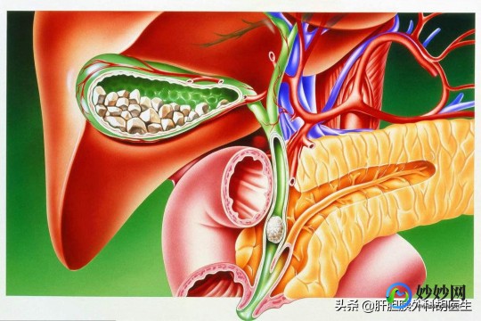 胆囊息肉治疗,如何消除胆囊息肉