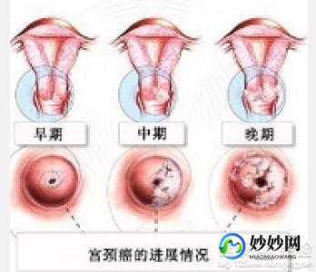 菜花状是什么形状图,宫颈口菜花状图片