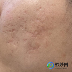 脸上很多坑,脸上很多痘坑怎么处理