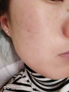 脸颊两边红红的是什么原因,脸颊两边一直红红的