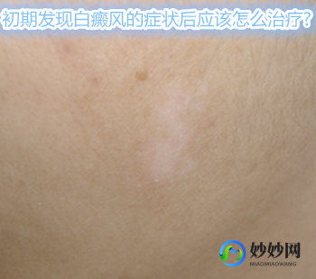 白癜风症状,白癜风有什么症状