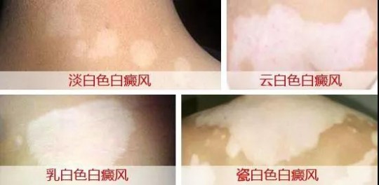 白癜风症状,白癜风有什么症状