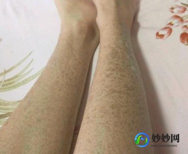 蛇皮病,蛇皮病能治吗