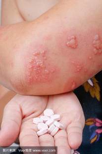 疱疹特效药,疱疹病毒用什么药最好