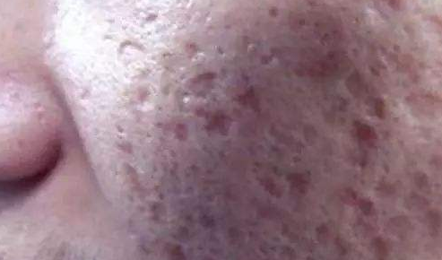 怎样去掉脸上的痘坑,脸上很多痘坑怎么处理