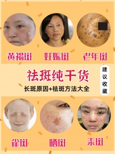 祛斑怎么得的,祛斑是什么原因
