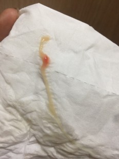 白带有血,白色带血分泌物怎么回事