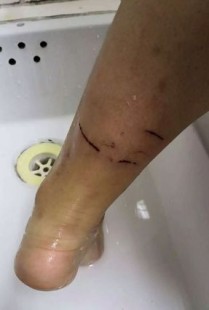 二期缝合,狗咬伤二期缝合的时间和条件
