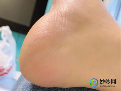 脚跟干裂的原因及治疗方法,脚后跟干裂