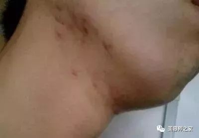 腋下长了一个小疙瘩是什么东西,腋下有一个凸起的小疙瘩
