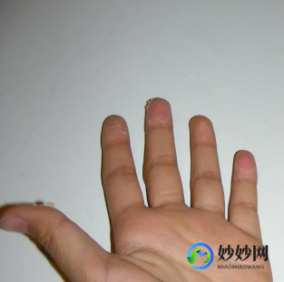 手蜕皮,手皮肤脱皮