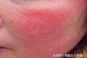 脸颊有红血丝怎么办,脸颊发红有红血丝怎么办