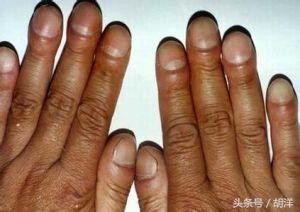 进行性肌无力,进行性肌无力的症状