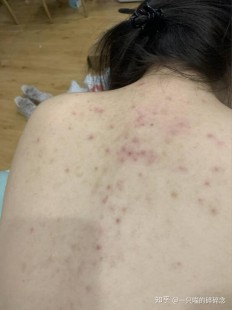 痤疮疙瘩,痤疮型痘痘怎么消除