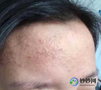 痤疮疙瘩,痤疮型痘痘怎么消除