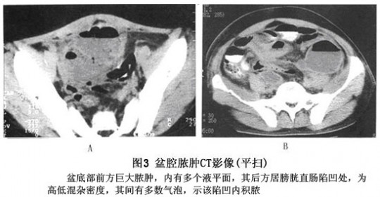 盆腔脓肿,盆腔脓肿是什么原因引起的,该怎么治疗