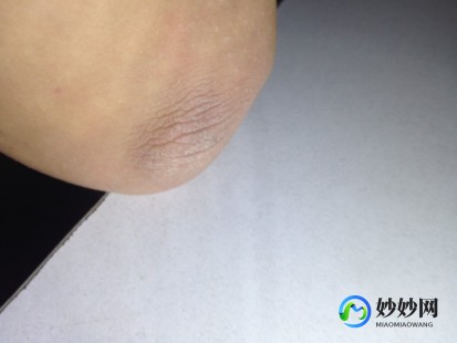 胳膊皮肤粗糙,手臂上皮肤一块块粗糙