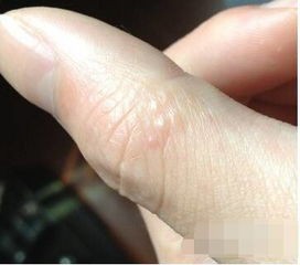 手指上长了类似水泡的小疙瘩,手上长像水泡一样的疙瘩是怎么回事