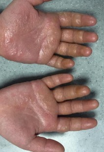手指上长了类似水泡的小疙瘩,手上长像水泡一样的疙瘩是怎么回事