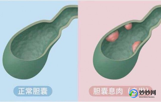 胆囊息肉怎么调理可以变小,如何消除胆囊息肉