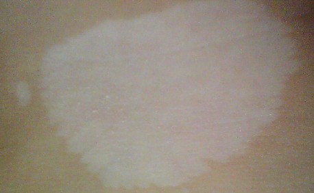 白癫风症状,白癜风有什么症状