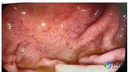 阴息肉,阴壁息肉是怎么回事