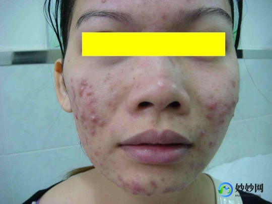治疗青春痘痤疮,青春痘如何控制和消除