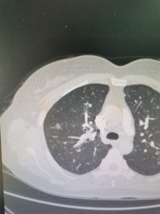 肺部磨玻璃结节意味着什么,肺磨玻璃结节是什么