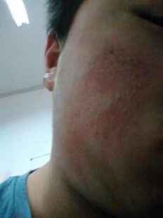 脸冻伤了怎么办,脸冻了怎么缓解