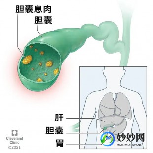 胆囊息肉是怎么回事,为什么会有胆囊息肉
