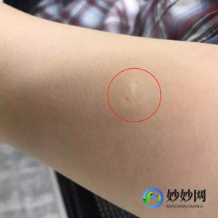 胳膊上的疤是什么疫苗,手臂上的疤痕是什么疫苗