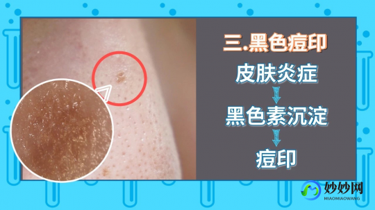 脸上的痘坑,脸上很多痘坑怎么处理