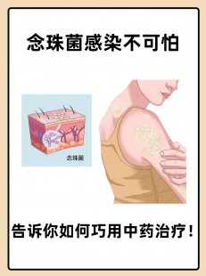 白色念珠菌吃什么药,白色念珠菌感染吃什么药