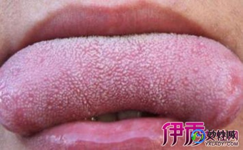 白色念珠菌吃什么药,白色念珠菌感染吃什么药
