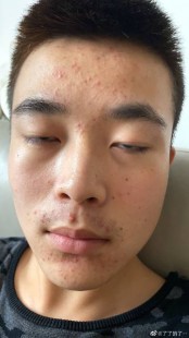 男士去粉刺,青春期的男孩脸上有很多粉刺怎么办