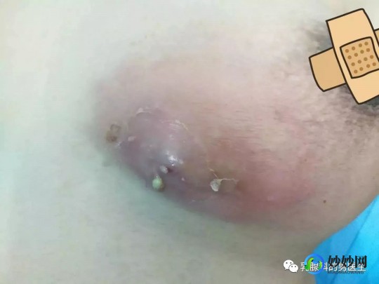 脓肿是什么病严重吗 男性,脓肿是什么病