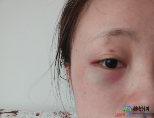 脸打肿了怎么办,脸打肿了怎么快速消肿冷敷还是热敷