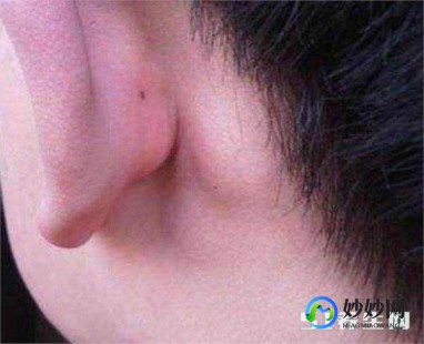 耳朵后面增生疙瘩怎么办,耳朵后面长了个疙瘩怎么办