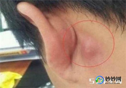 耳朵后面增生疙瘩怎么办,耳朵后面长了个疙瘩怎么办