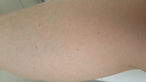 身上起小水泡,身上无缘无故长水泡