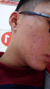男生去粉刺,青春期的男孩脸上有很多粉刺怎么办