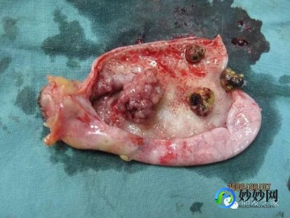 胆囊息肉怎么治疗最好的方法,如何消除胆囊息肉