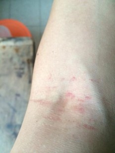 膝盖红了是什么意思,膝盖莫名出现一块红色