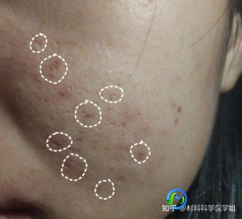 有痘坑怎么办,脸上很多痘坑怎么处理