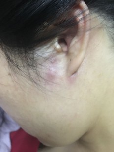 耳朵旁边长了一个硬疙瘩是怎么回事,耳朵旁边长了一个硬疙瘩是怎么回事