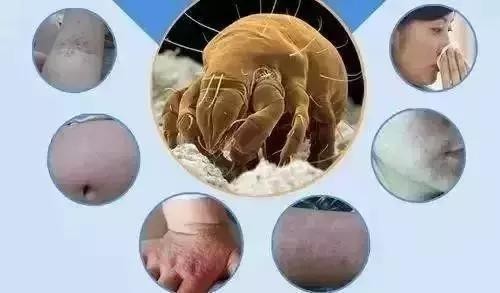 青春痘破了怎么办,青春痘破了流血怎么办