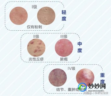 青春期痤疮治疗,青春期长痘严重怎么办